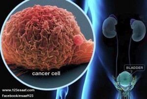 معظم الإصابات بسرطان المثانة ناتجة عن البلهارسيا - 123esaaf.com