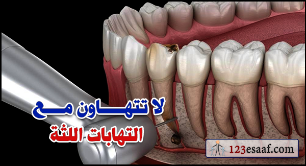 لا تتهاون مع التهابات اللثة