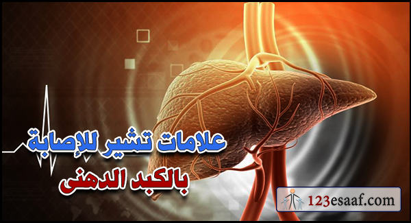 علامات تشير للإصابة بالكبد الدهنى