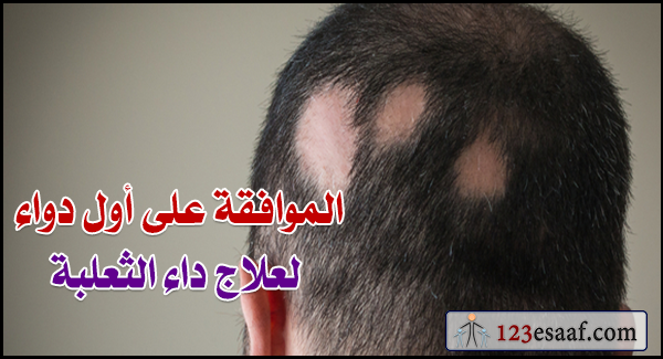 الموافقة على أول دواء لعلاج داء الثعلبة