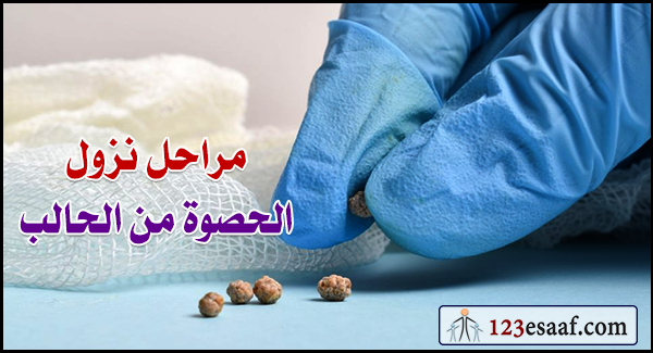 مراحل نزول الحصوة من الحالب