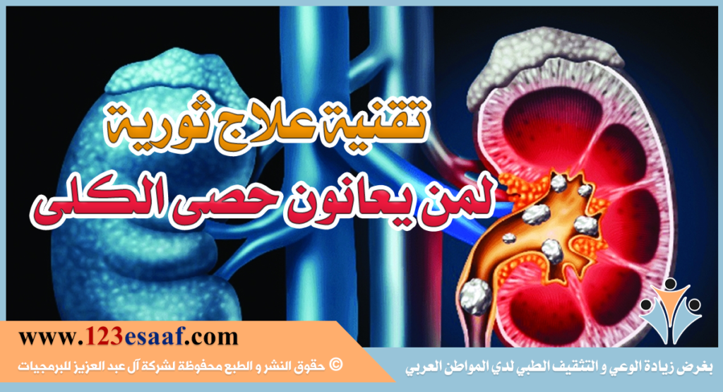 تقنية علاج ثورية لمن يعانون حصى الكلى