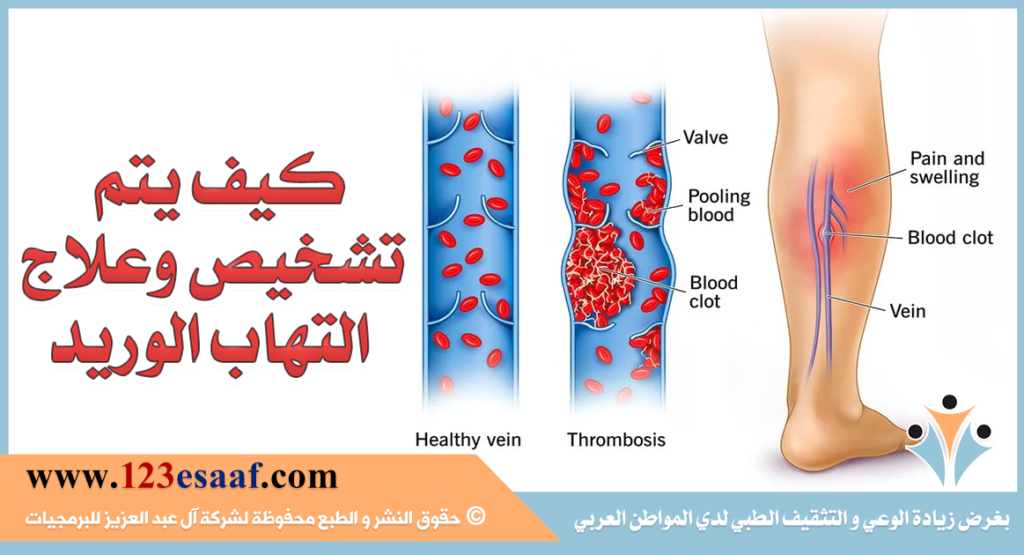 كيف يتم تشخيص وعلاج التهاب الوريد