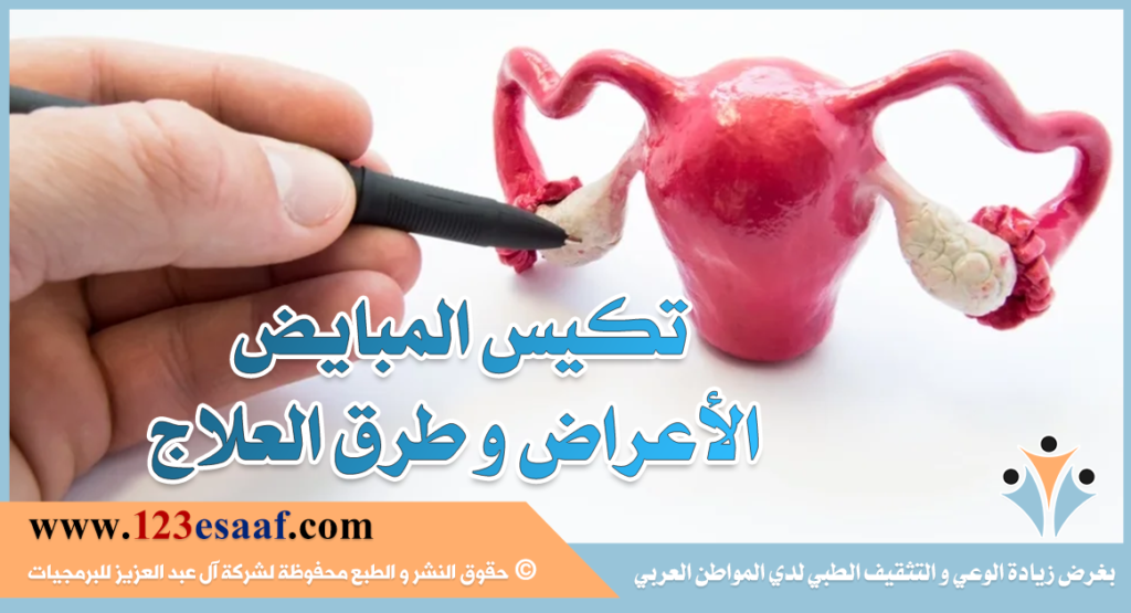 تكيس المبايض الأعراض و طرق العلاج