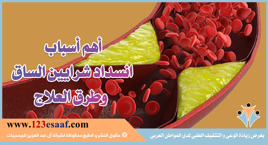 أهم أسباب انسداد شرايين الساق وطرق العلاج