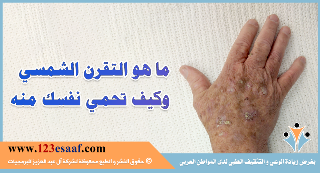 ما هو التقرن الشمسي وكيف تحمي نفسك منه