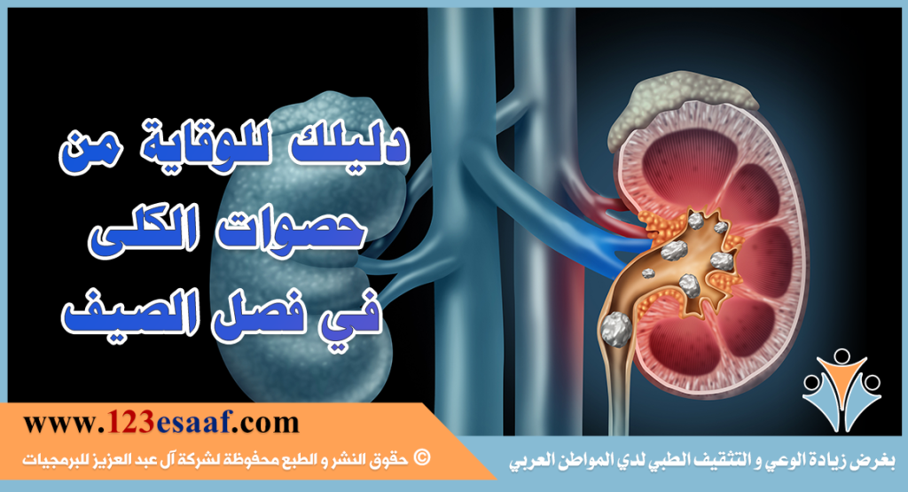 دليلك للوقاية من حصوات الكلى في الصيف