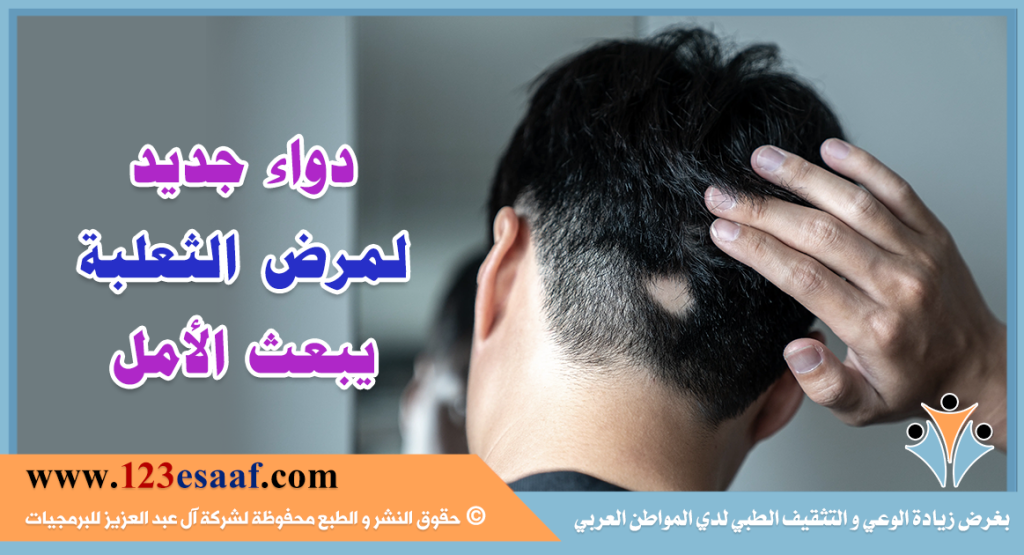 دواء جديد لمرض الثعلبة يبعث الأمل