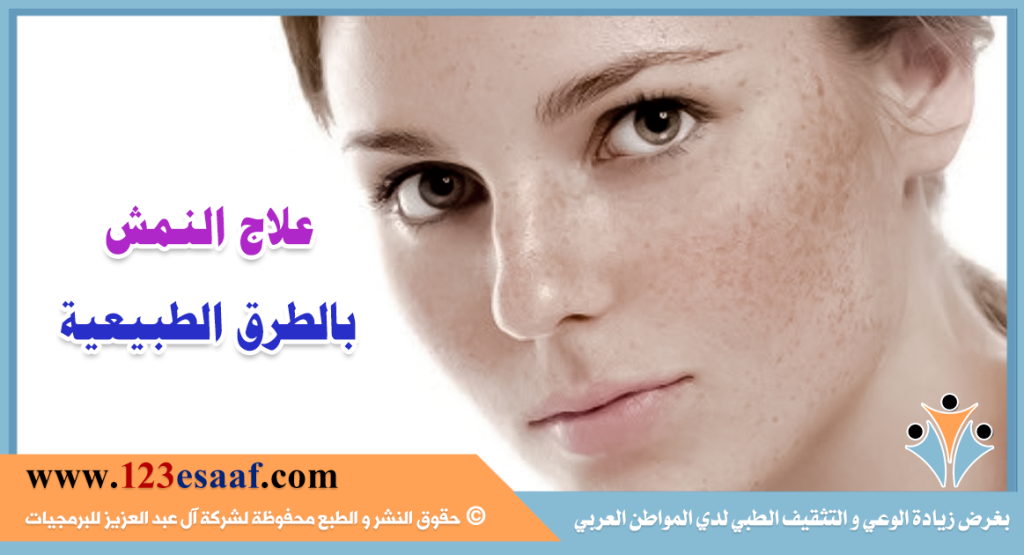 علاج النمش بالطرق الطبيعية