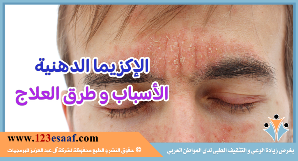 الإكزيما الدهنية الأسباب و طرق العلاج