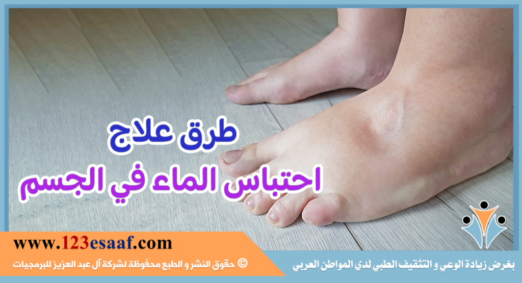 طرق علاج احتباس الماء في الجسم