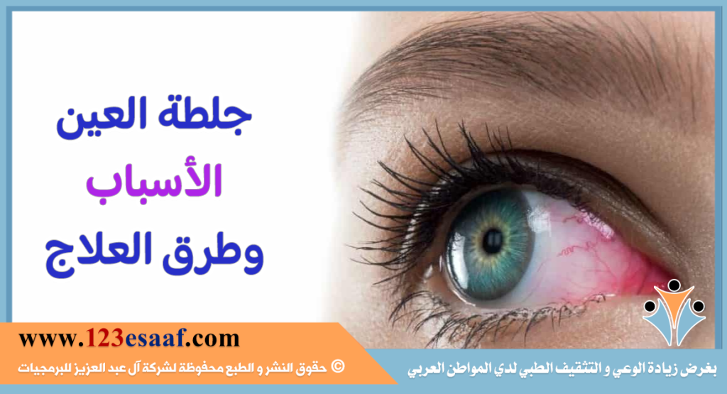 جلطة العين الأسباب وطرق العلاج