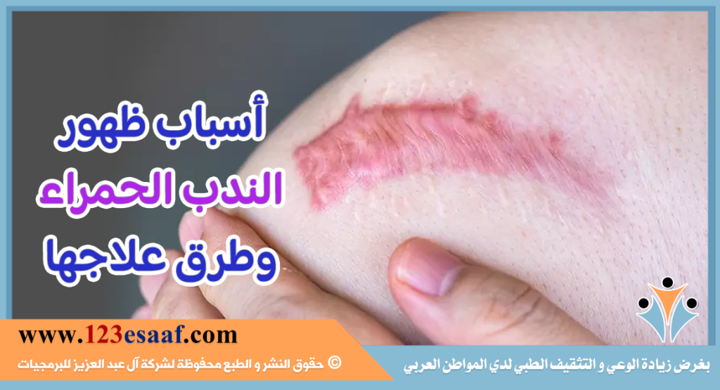 أسباب ظهور الندب الحمراء وطرق علاجها