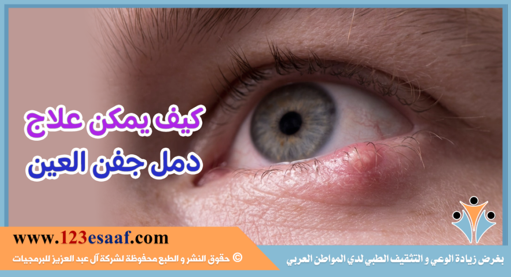 كيف يمكن علاج دمل جفن العين