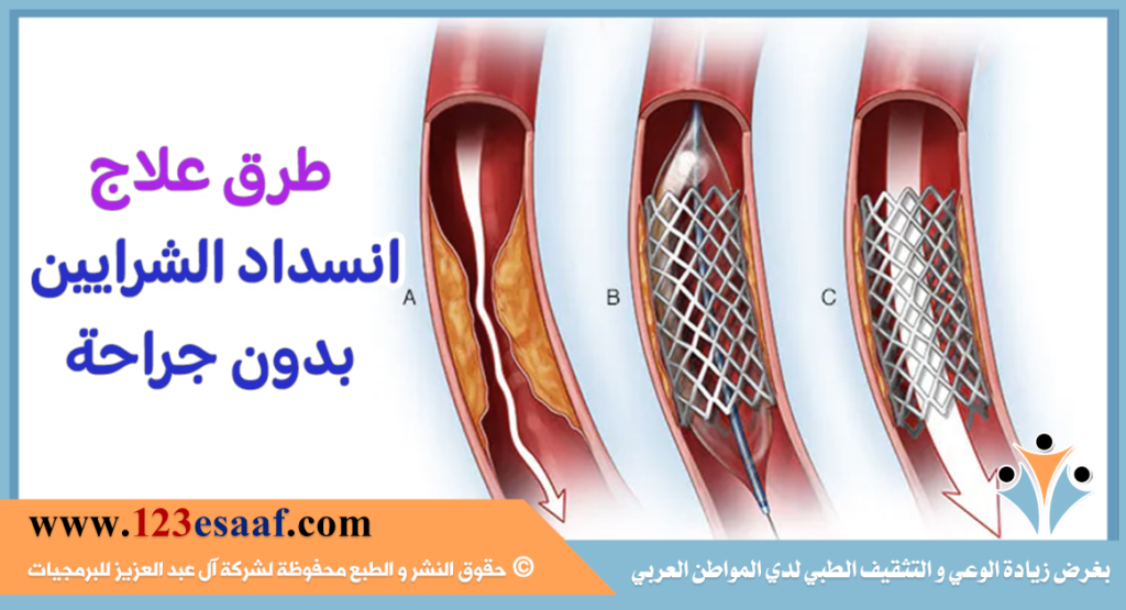 طرق علاج انسداد الشرايين بدون جراحة