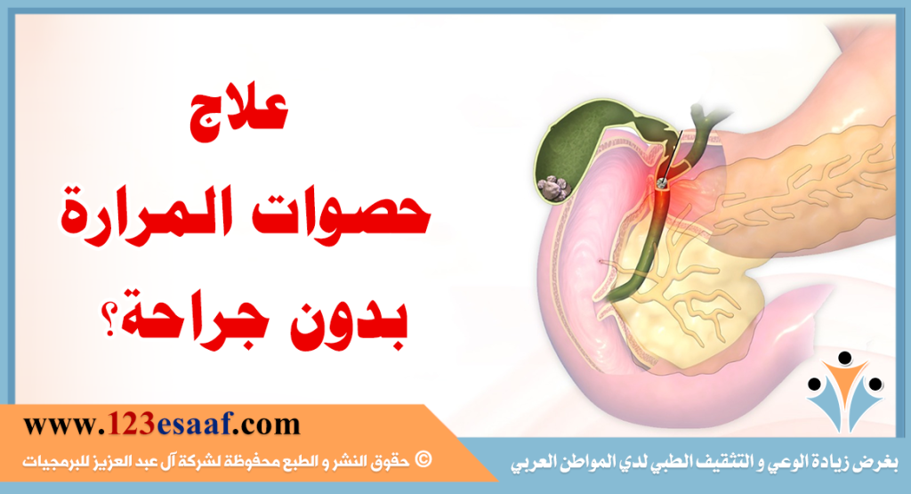 علاج حصوات المرارة بدون جراحة