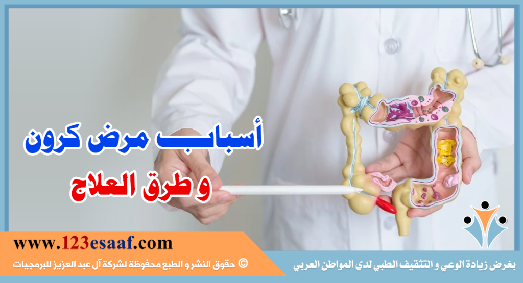 أسباب مرض كرون و طرق العلاج