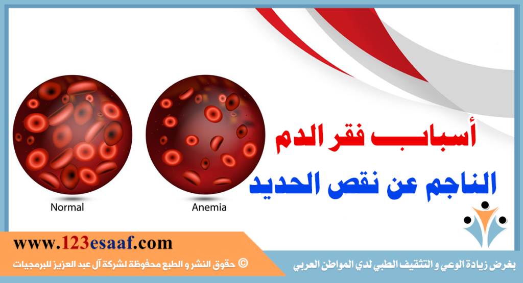 أسباب فقر الدم الناجم عن نقص الحديد