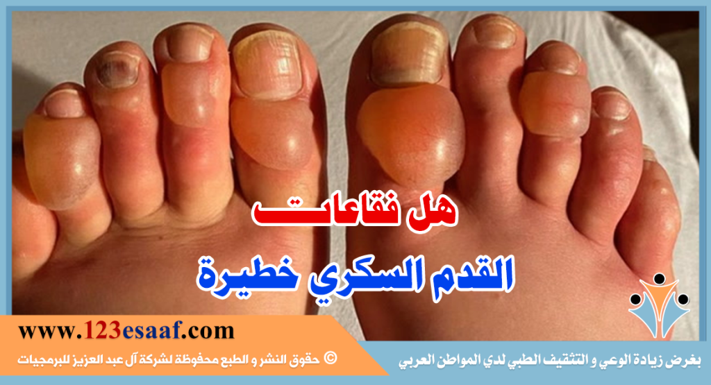 هل فقاعات القدم السكري خطيرة
