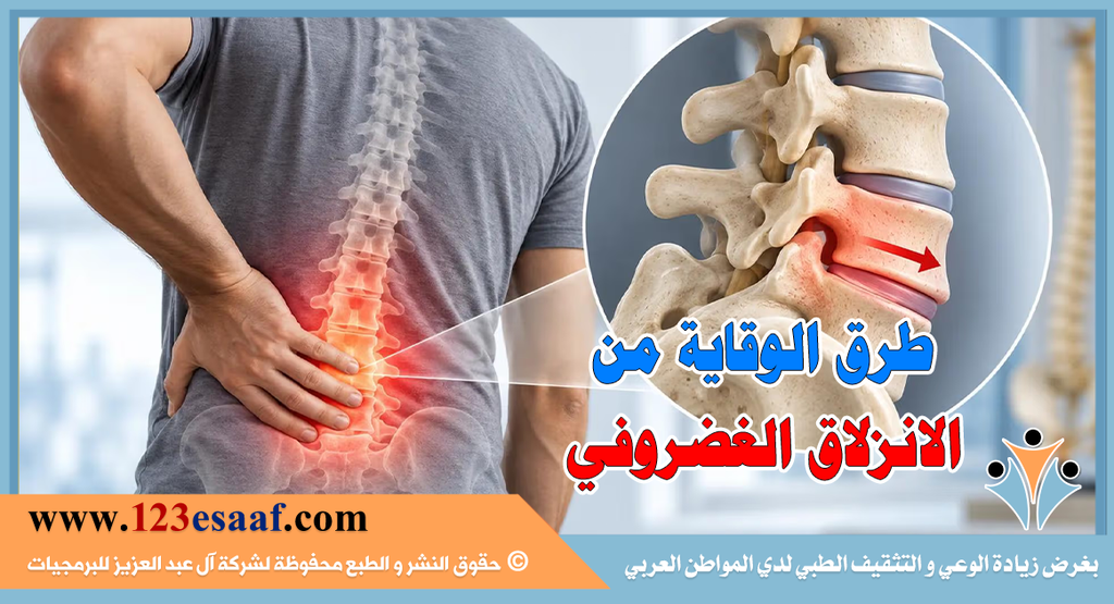 طرق الوقاية من الانزلاق الغضروفي